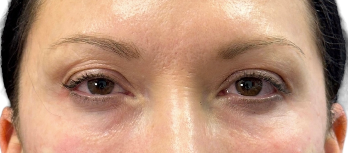 Before After Under Eye Ez Gel Treatment 1