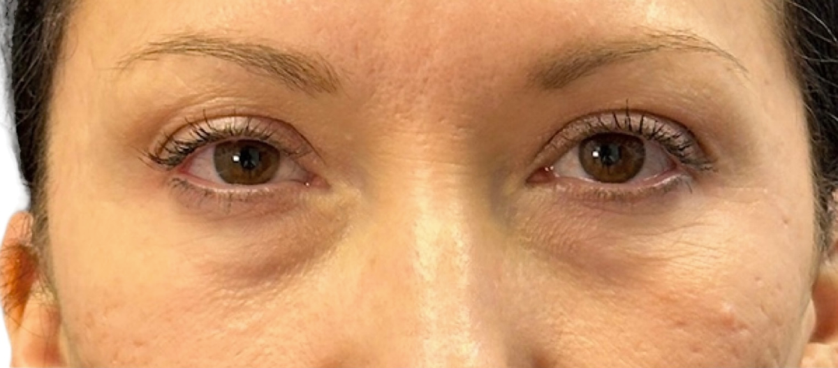 Before After Under Eye Ez Gel Treatment