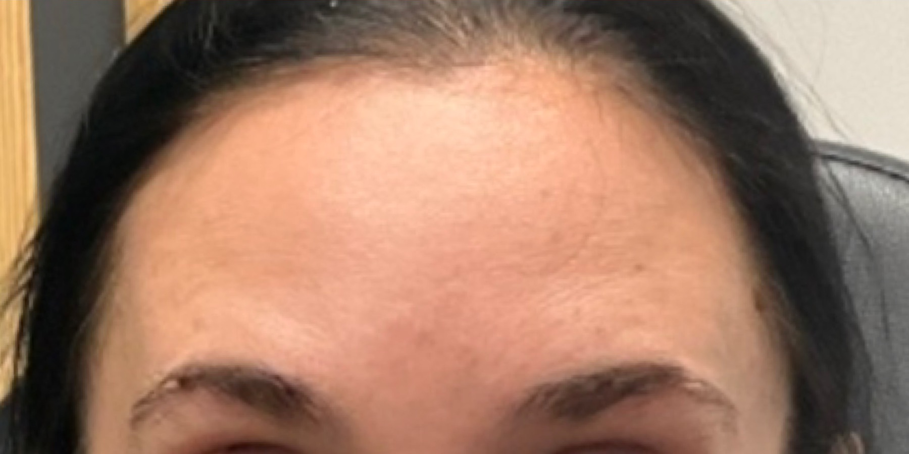 Upper Face Treatment6 1